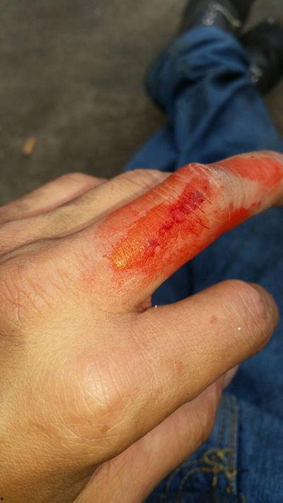 手腕流血真实照片,手腕割伤的真实写照